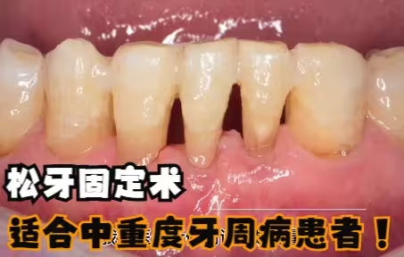 重度牙周病患者：鬆動牙，死活不願拔！——醫生決定先綁起來觀察